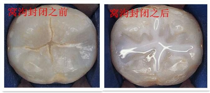 9岁的孩子蛀牙还没有换怎么办,9岁孩子蛀牙需要补牙吗