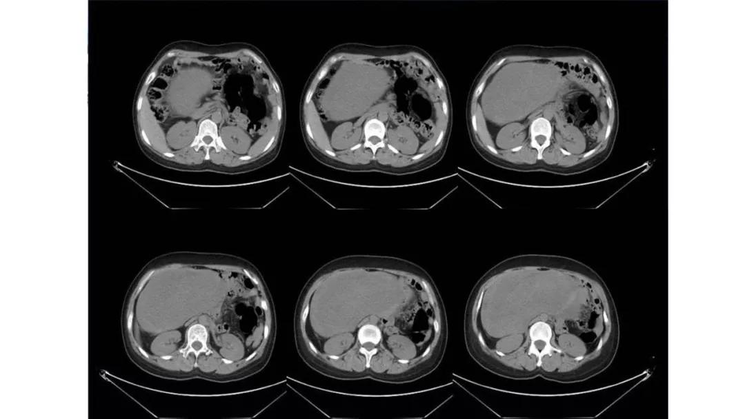 卵巢原发肿瘤的分析思路