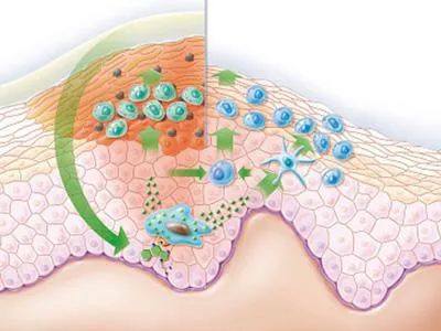 女性尖锐湿疣的症状都有哪些特征