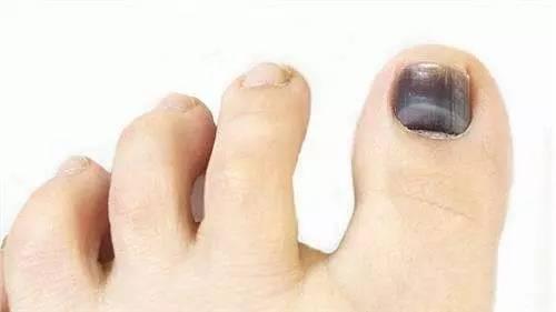 跑步为什么有黑指甲,跑步黑脚趾怎么办