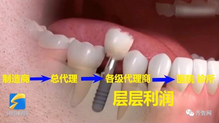 种植牙价格虚高监管出手整治,种植牙乱象调查