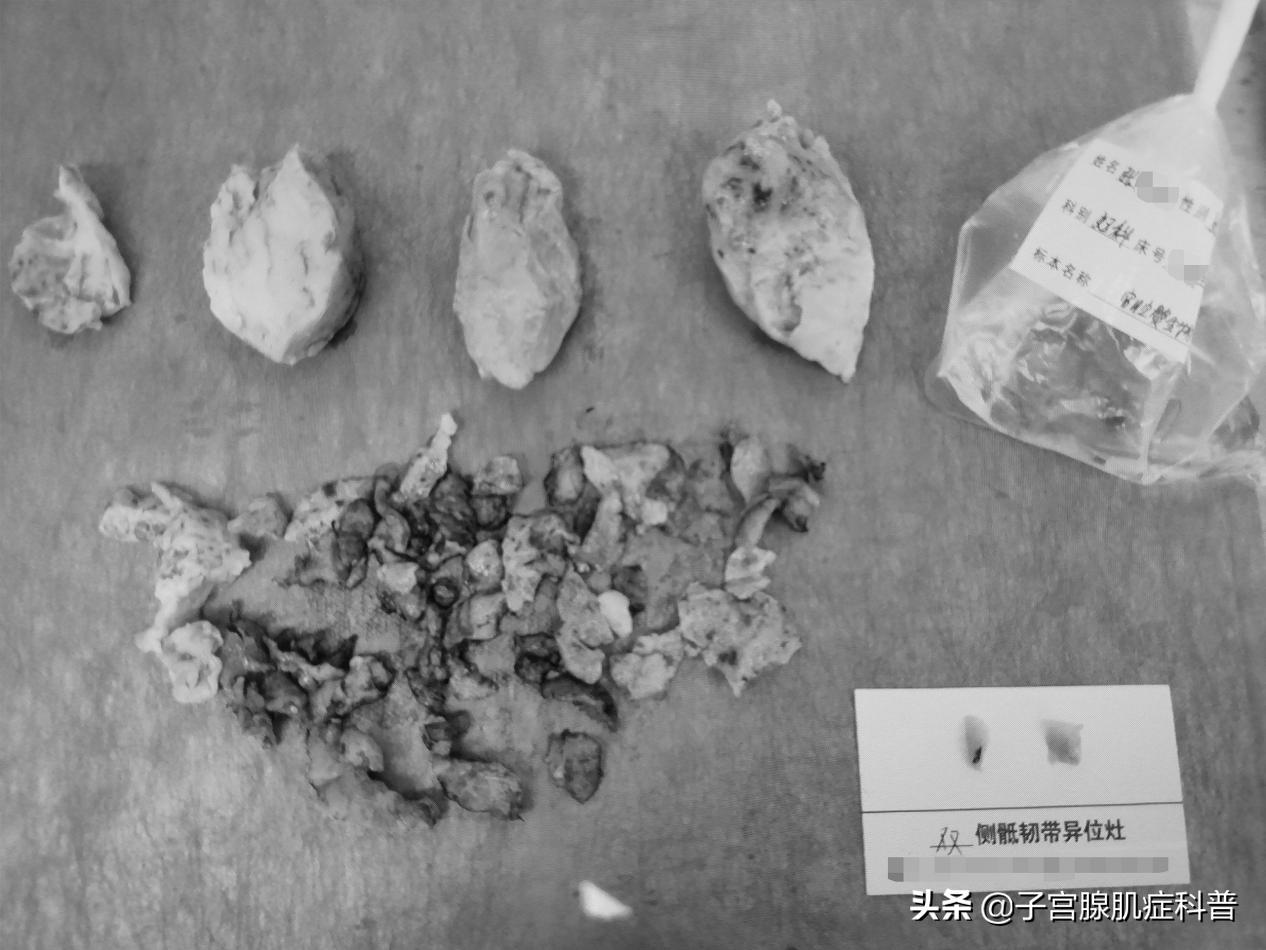 中医推拿真能缓解子宫腺肌症吗,子宫腺肌症推拿