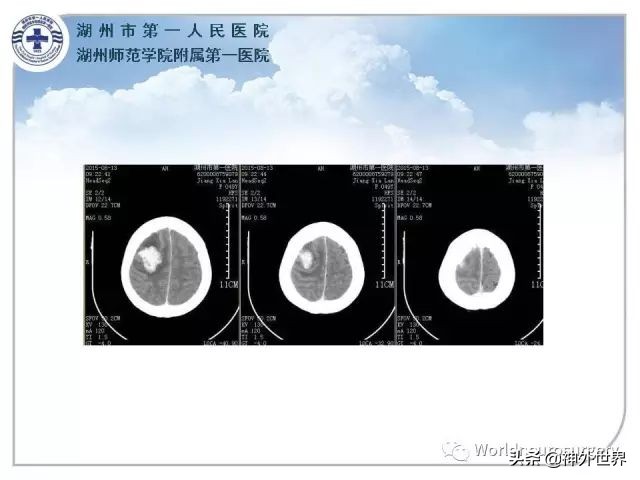 头皮裂伤缝合手术切口分类,头皮切口