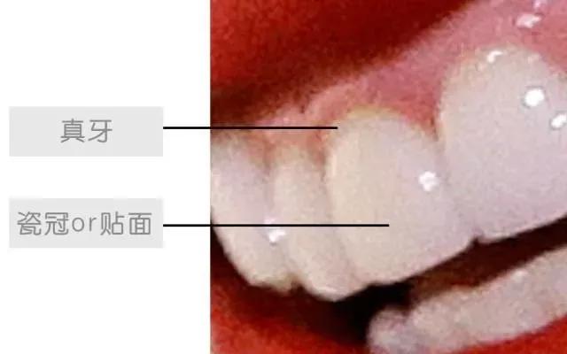 明星的牙都是真牙吗,如何辨别优秀的牙医