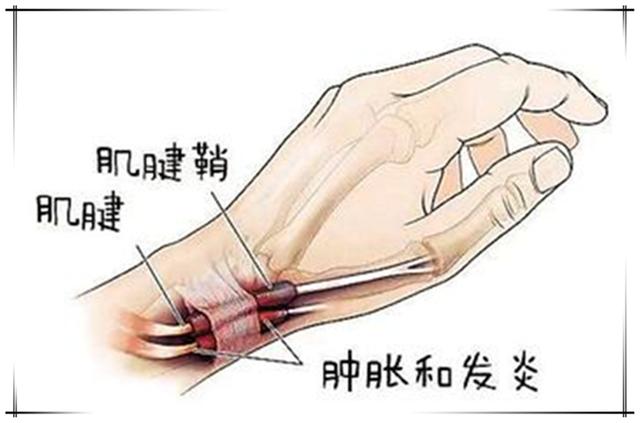 妈妈手怎么处理,妈妈手如何恢复健康