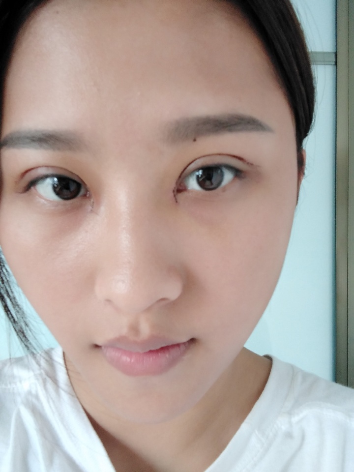 韩美做双眼皮,南昌韩美医院做双眼皮怎么样