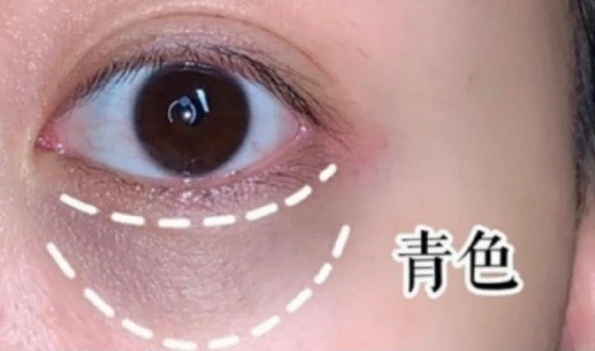 小孩子长黑眼圈怎么办,没熬夜为什么长黑眼圈