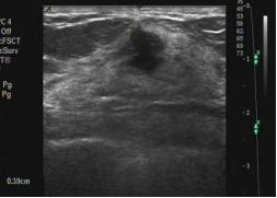 乳腺彩超报告中隐藏的秘密,乳腺结节4a怎么判断良性还是恶性