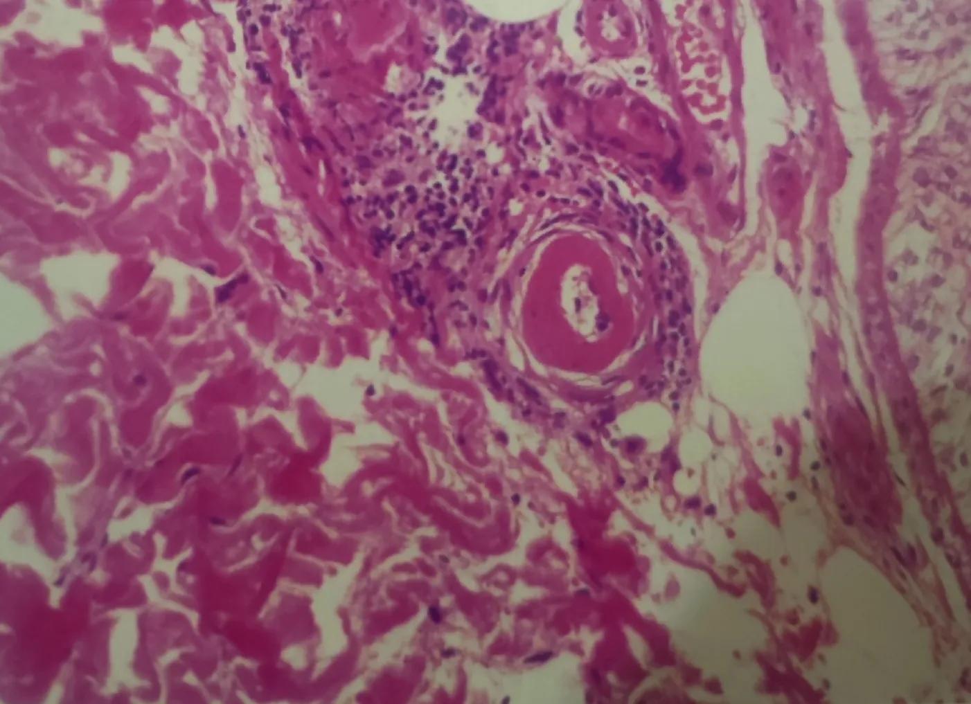 小腿上黑色疤痕怎么回事,小腿上的一个疤痕发黑