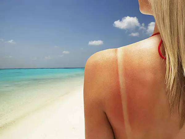 攻略|晒后脸部泛红、爆痘、长斑?晒后修复,你只有72小时