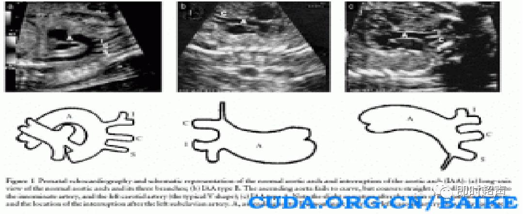 胎儿心脏三种血管关系模式图,25周的胎儿心脏弓切面多少正常
