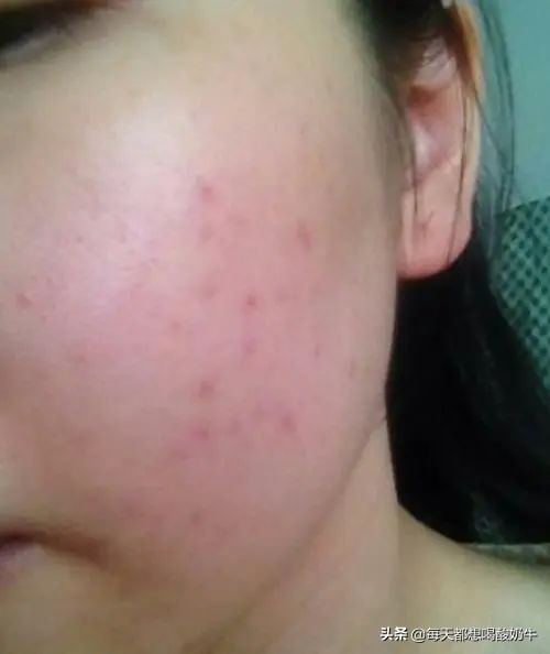 脸部毛孔大泛红有红血丝,脸部毛孔粗大有红血丝怎么改善