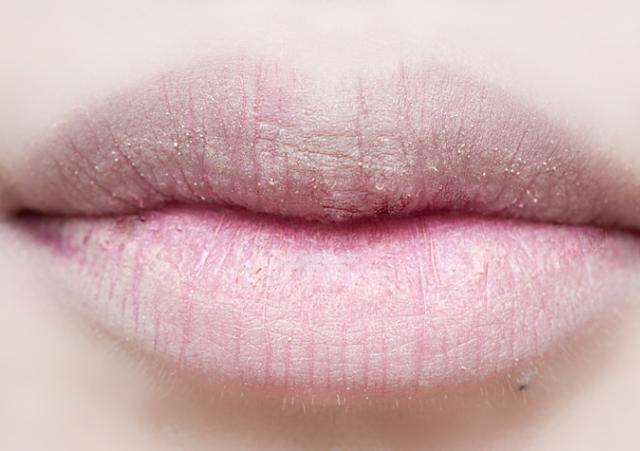 燥痹的症状和治疗方法,燥痹中医诊断标准