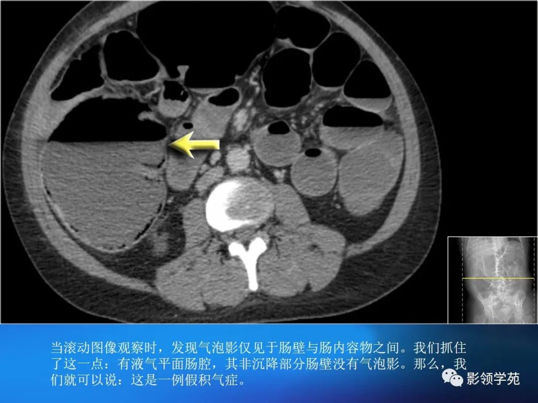 肠道内壁增厚,肠道扩张ct表现