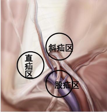 腹股沟疝怎么治,什么是腹股沟疝气啊