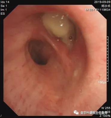 肺癌伴胸腔积液伴膨胀不全,肺癌晚期转移到肝脏引起腹腔积液