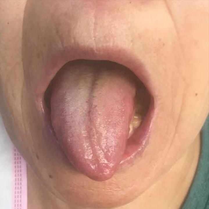 老人大便便秘的解决方法,老人口干便秘怎么调理最快