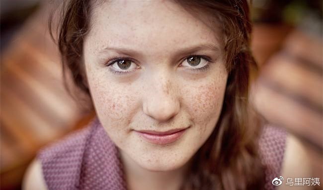 遗传雀斑用皮秒祛斑还是激光祛斑,雀斑激光祛斑好还是药水祛斑好