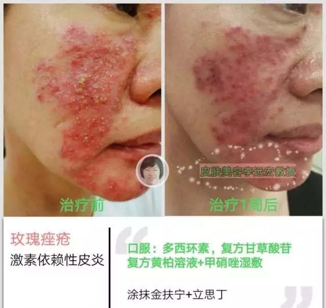 酒渣鼻有什么特效药,酒渣鼻的原因及治疗