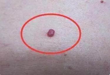 身上突然长咖啡色肉痣是咋回事,身上出现红色痣一定与肝脏有关吗