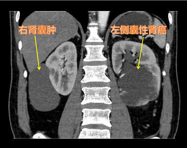 囊性肾癌与囊肿的区别,复杂肾囊肿和囊性肾癌