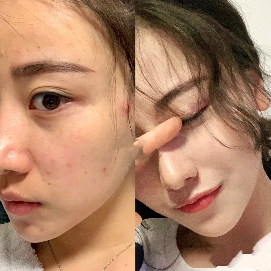 如何远离痘痘肌,远离痘痘的方法