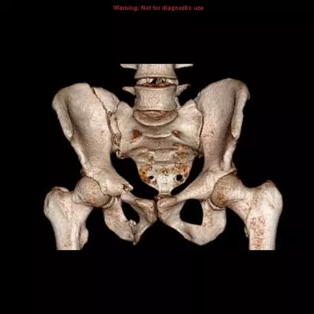 所有骨折都叫什么名字,骨折的名称有哪些