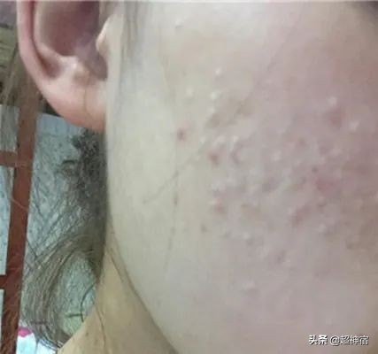 比痘痘更烦人的闭口来了,最有效的去闭口*法大**看过来