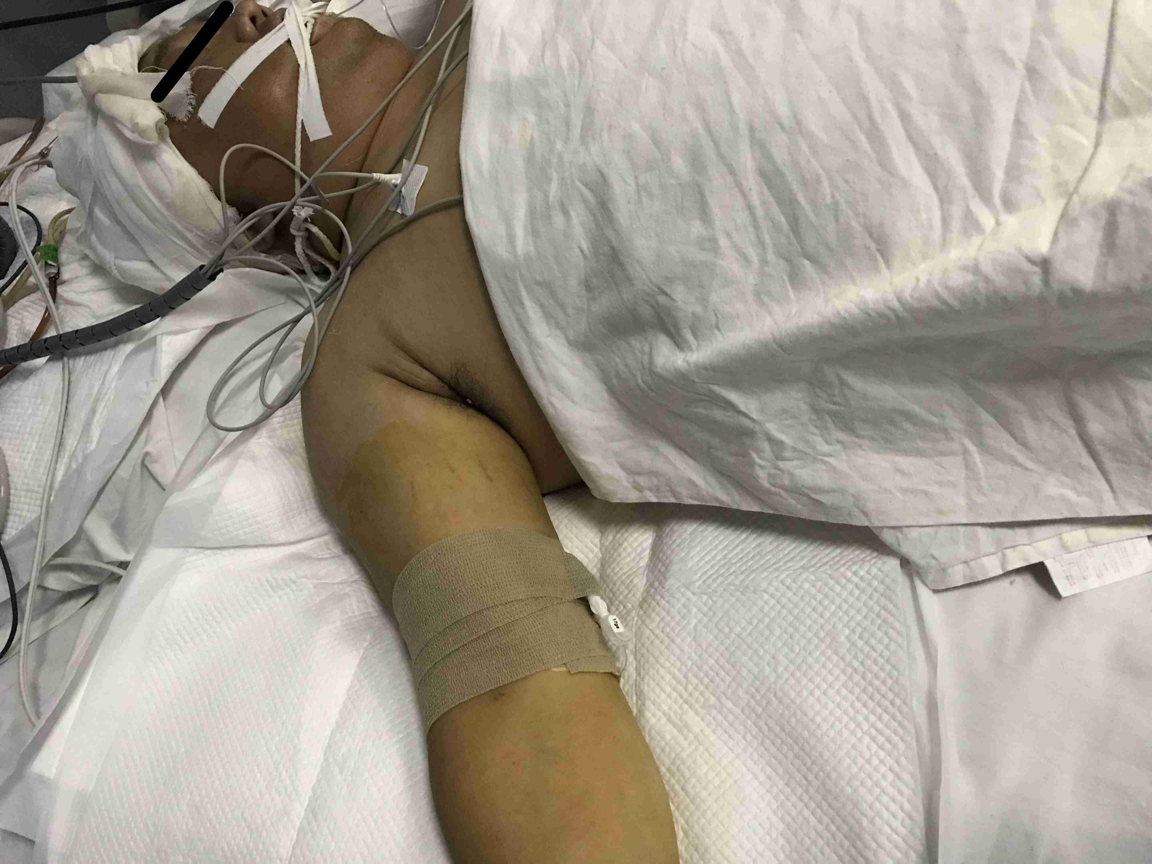 picc日常注意事项,picc生命的通道