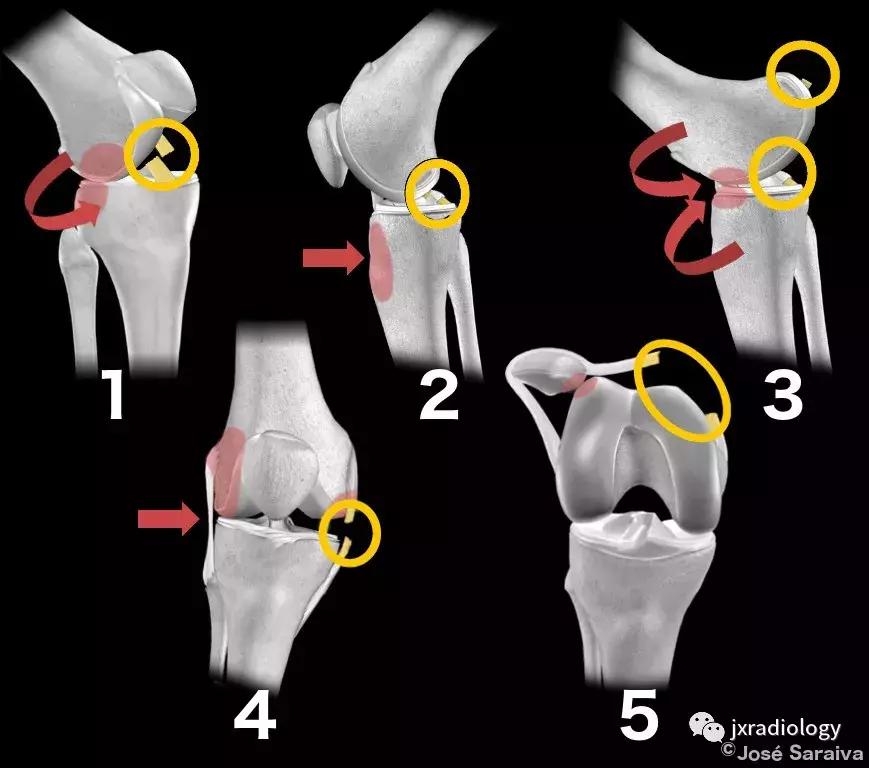 磁共振天天诊断骨髓水肿，但您知道原因吗？