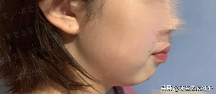 不靠整容怎么改变下巴后缩?看这里