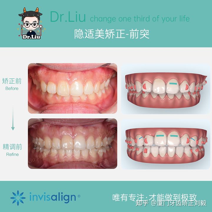拔牙正畸矫正全过程3d,拔牙嘴凸正畸的真实案例