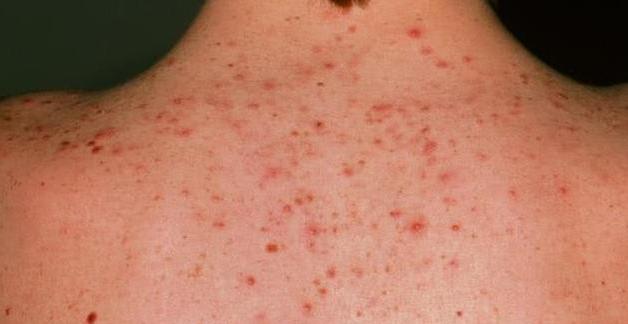 后背有痘痘和小米粒一样,后背痘痘总是留下黑印