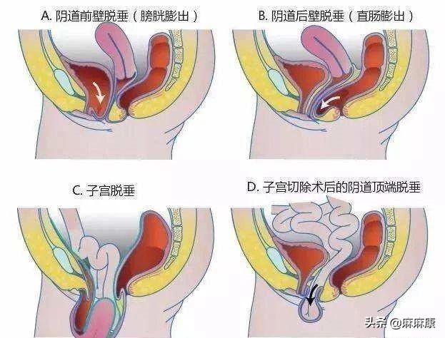 怎么样自检盆底肌情况,产后怎么自检盆底肌