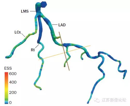 冠脉CT血管造影诊断高危斑块病变影像学特征分析