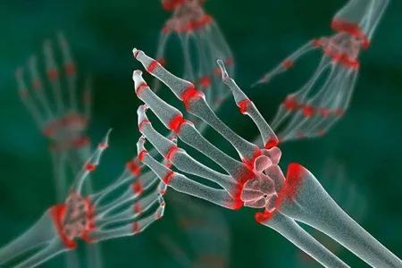 类风湿性关节炎被称为不死的癌症,类风湿为何称不死的癌症