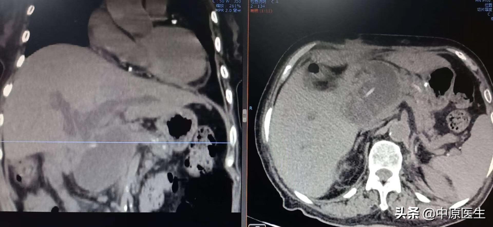 团队工作：老太太患黄疸规范治疗后仍高烧，转到介入科很快治好了