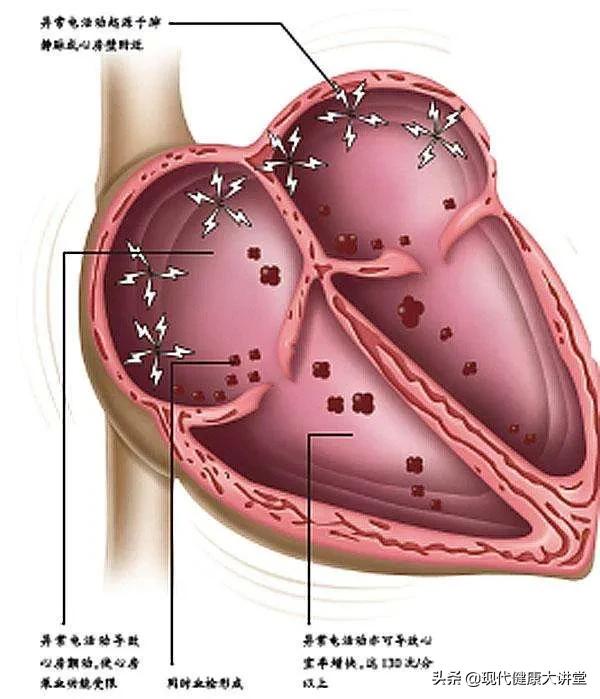 心房颤动的症状,心房颤动的临床特点