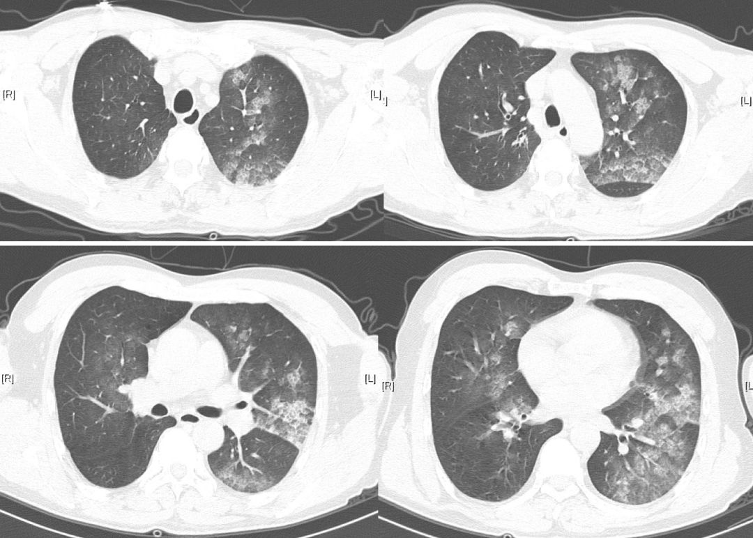 工人用稀料清理泡沫10分钟即意识丧失,肝功能异常是否为切入点?