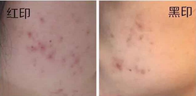 如何去除痘印,挤破痘痘后怎么处理才会不留痘印