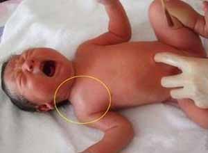 什么是新生儿锁骨骨折？该怎样护理！