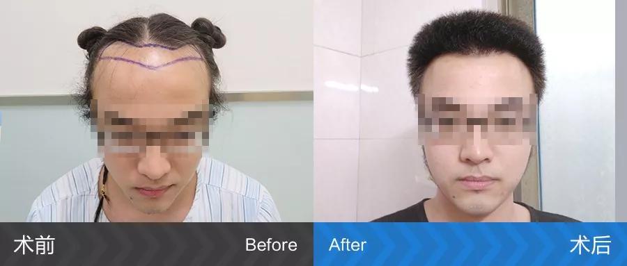 发际线后移额角大头发稀疏怎么办,额角发际线还能恢复吗