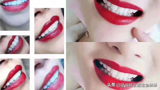 现在最好的烤瓷牙材料,做的烤瓷牙有点黄怎么补救