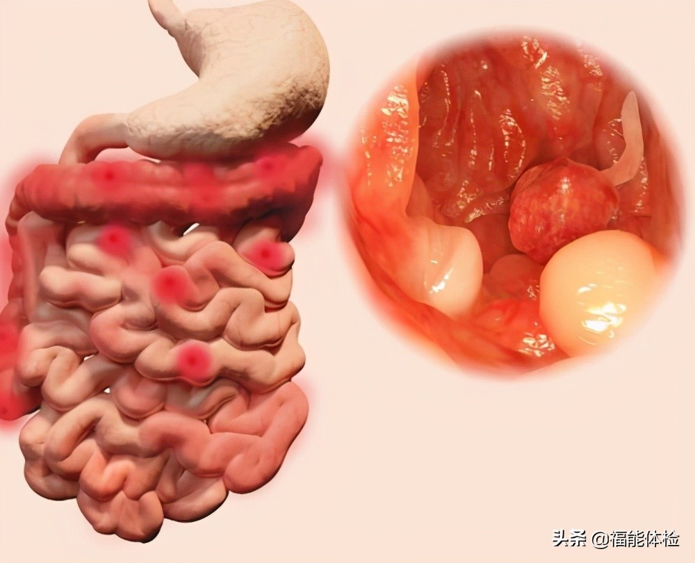 肠息肉切除后多久复查一次肠镜,肠息肉切除后多久复查一次