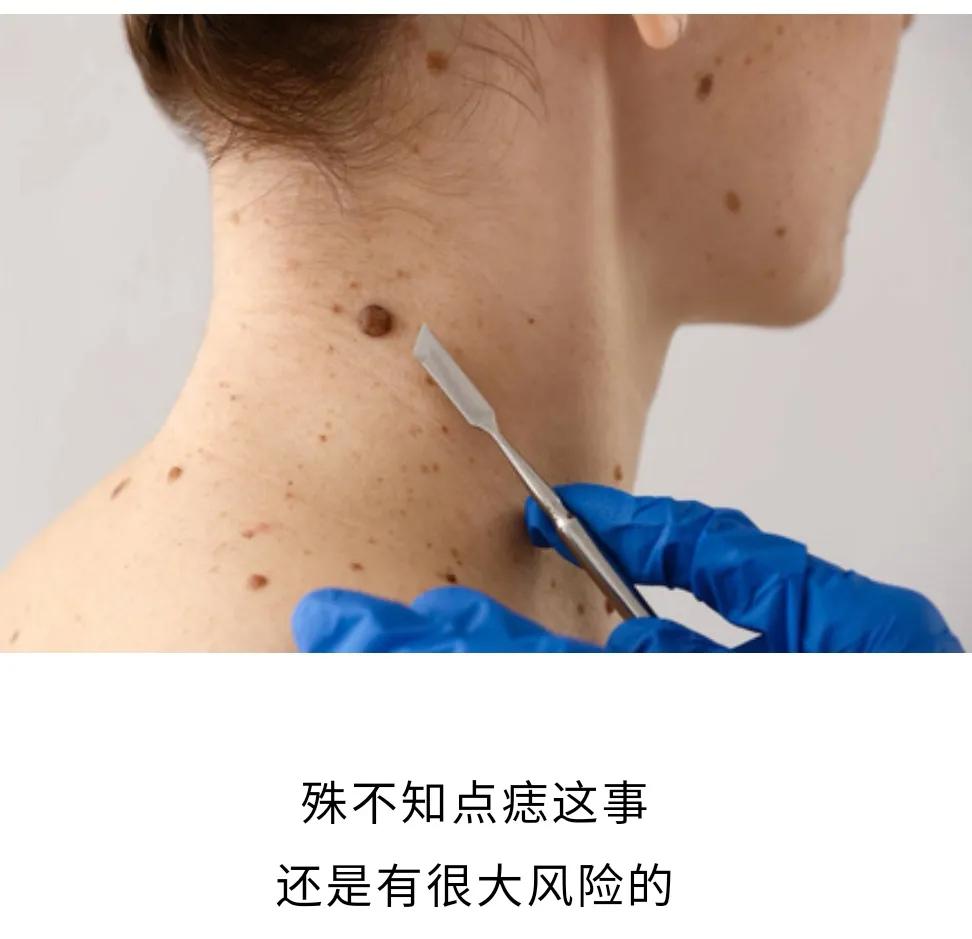 身上的黑痣该不该去除,身上的黑痣要不要点