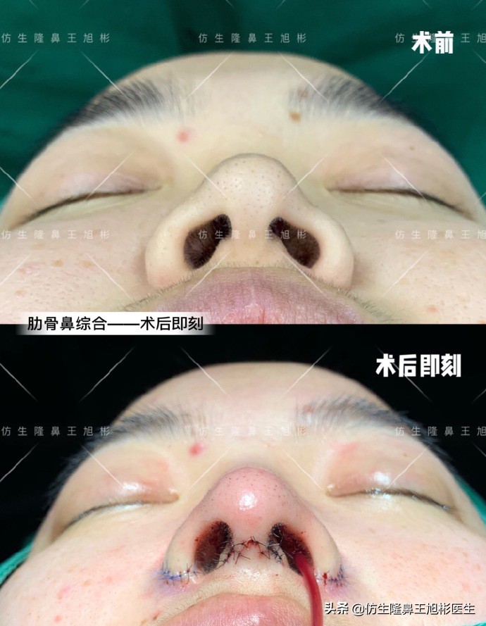 外切缩鼻翼的后遗症,外切鼻翼缩小会回弹吗