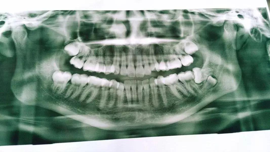 那些不拔智齿的人后来都怎么样了,那些该拔不拔的智齿最后都咋样了