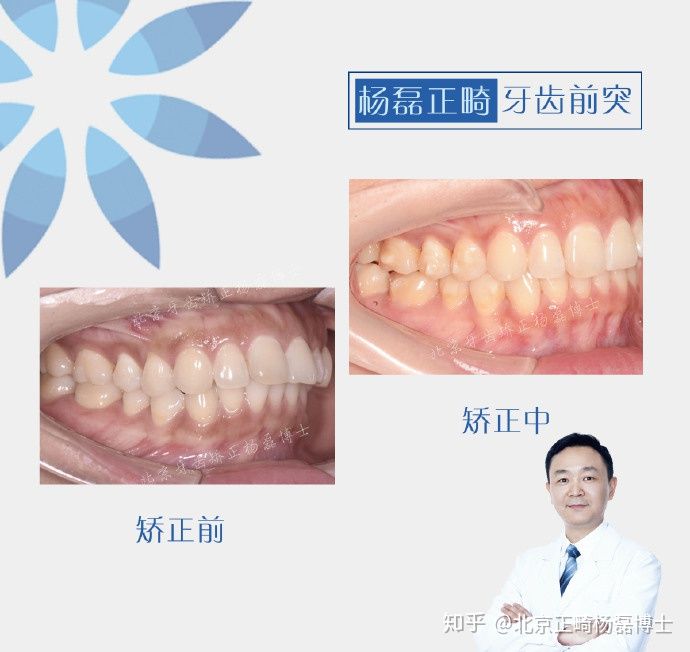 拔牙正畸治疗龅牙,门牙外突不拔牙正畸案例