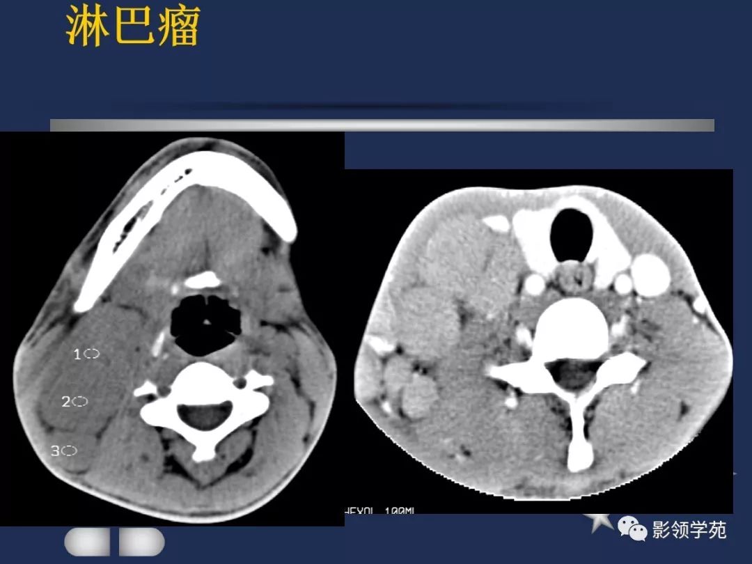 腮腺疾病影像学诊断,腮腺肿块影像诊断