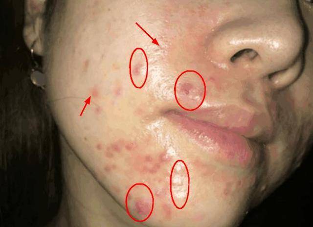 怎么分清螨虫造成的毛孔粗大,毛孔内螨虫怎么解决